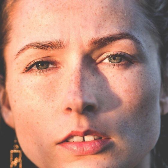 21 pigmentflecken 7d8d7cbf