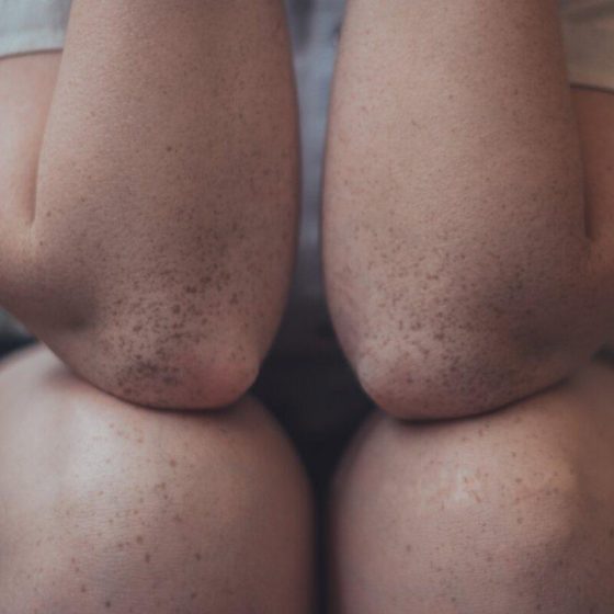 30 schuppenflechte 95154f72